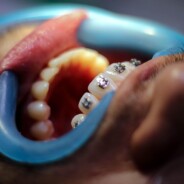 How Much Do Invisible Braces Cost and How Do They Work at a Dental Clinic in Catford?